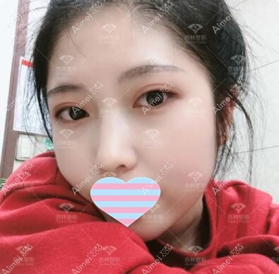 割双眼皮30天效果照 割双眼皮30天效果照