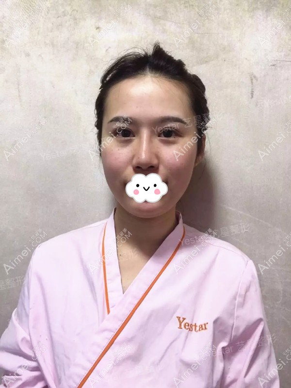 做完Yestar美杜莎综合美眼+BSK综合隆鼻术后五天效果 做完Yestar美杜莎综合美眼+BSK综合隆鼻术后五天效果