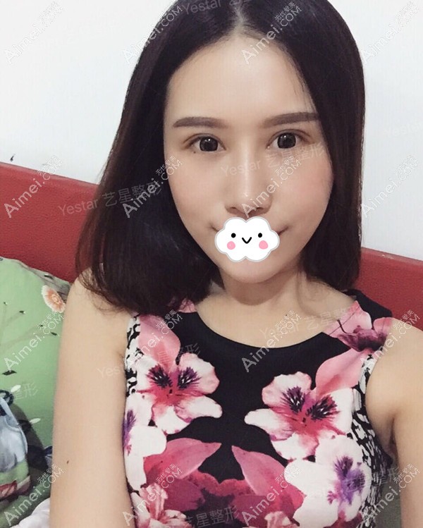 秦晓东医生做眼鼻综合术后一个月恢复化妆效果 秦晓东医生做眼鼻综合术后一个月恢复化妆效果
