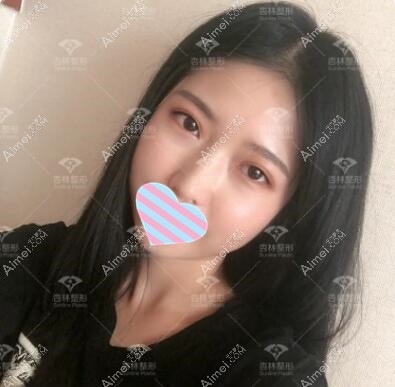 割双眼皮半年恢复效果照 割双眼皮半年恢复效果照