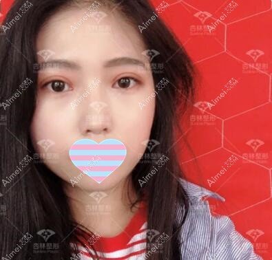 割双眼皮术后一周照 割双眼皮术后一周照