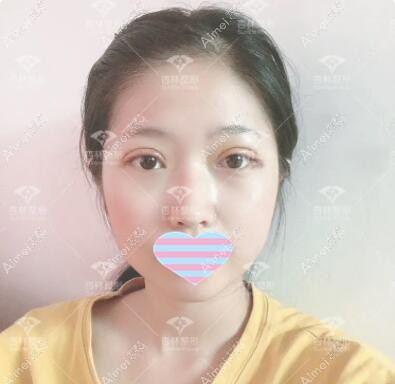 割双眼皮术后第3天 割双眼皮术后第3天