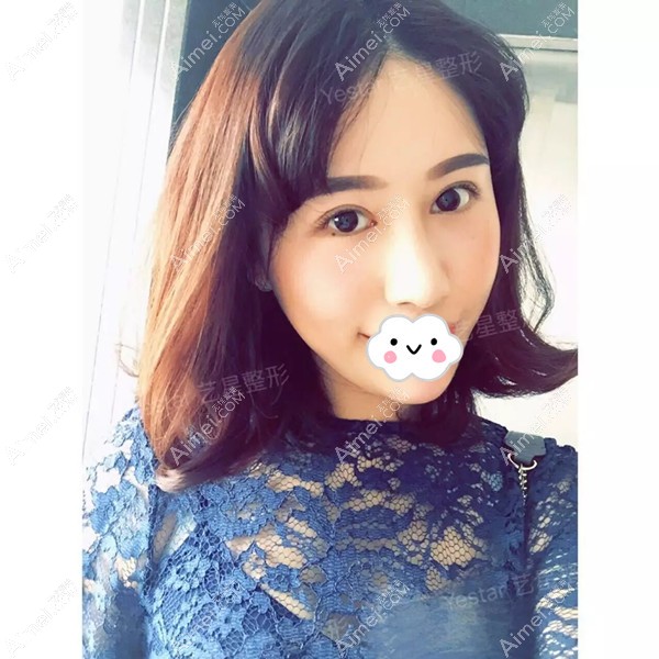 面诊长沙艺星做了综合美眼+BSK鼻综合 面诊长沙艺星做了综合美眼+BSK鼻综合