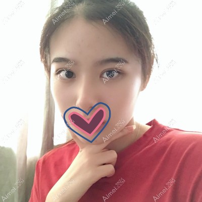 去嘉兴艺星做全切双眼皮术后三个月效果图