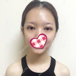 修复后六天效果 修复后六天效果