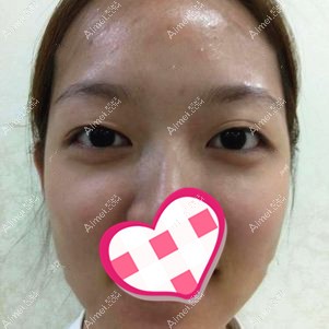 双眼皮失败需要修复 双眼皮失败需要修复