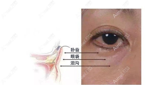 20201106498369.jpg 眼袋.jpg