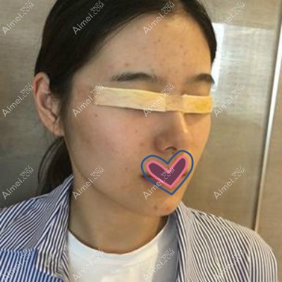 去嘉兴割双眼皮手术即刻效果图 去嘉兴割双眼皮手术即刻效果图