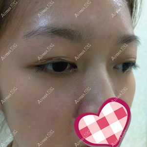 睁眼眼皮是多层 睁眼眼皮是多层