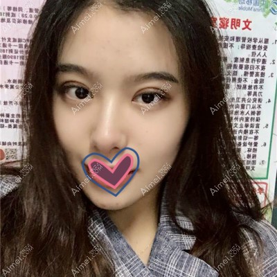 去嘉兴艺星割双眼皮术后半个月效果图 去嘉兴艺星割双眼皮术后半个月效果图