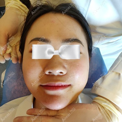 孔翔玉医生为我注射垫下巴即刻效果 孔翔玉医生为我注射垫下巴即刻效果