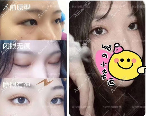 术前小内双双眼皮做完切开双眼皮+去皮去脂 术前小内双双眼皮做完切开双眼皮+去皮去脂