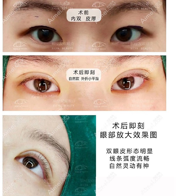 术前内双、眼皮厚,做了自然款外折小平扇双眼皮 术前内双、眼皮厚,做了自然款外折小平扇双眼皮
