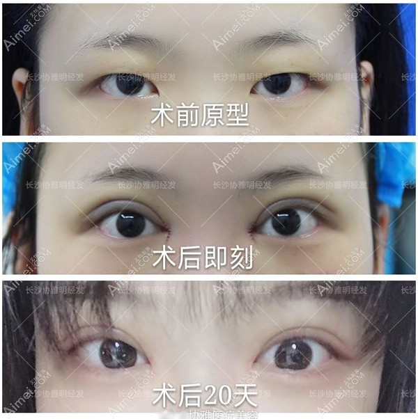 明经发医生切开双眼皮+去皮去脂内眼角案例 明经发医生切开双眼皮+去皮去脂内眼角案例