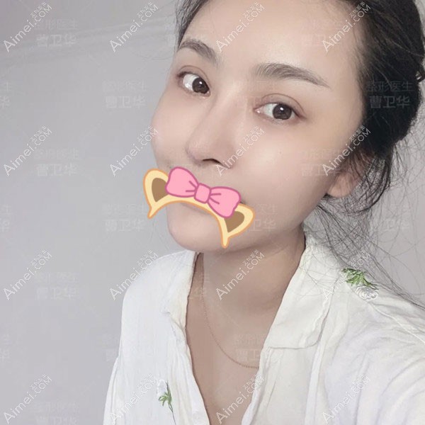 20201110711301.jpg 术后90天_副本_meitu_4.jpg