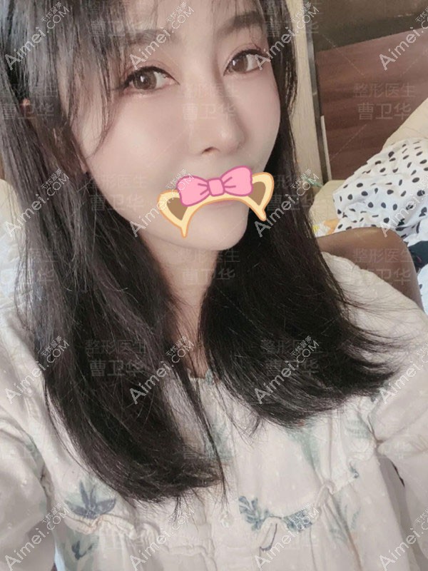 20201110815391.jpg 术后70天_副本_meitu_5.jpg