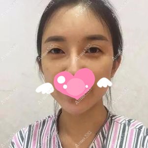 做眼综合术前下垂的眼睑 做眼综合术前下垂的眼睑