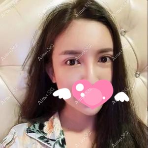 到兰州梦想做眼综合术后30天恢复效果 到兰州梦想做眼综合术后30天恢复效果