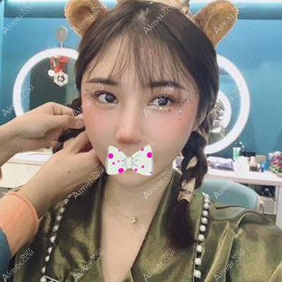 方观瑞医生为我做修复术后1个月双眼皮消肿 方观瑞医生为我做修复术后1个月双眼皮消肿