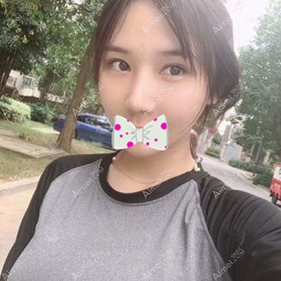 在南宁密斯做眼修复术后18天眼睛微肿胀 在南宁密斯做眼修复术后18天眼睛微肿胀