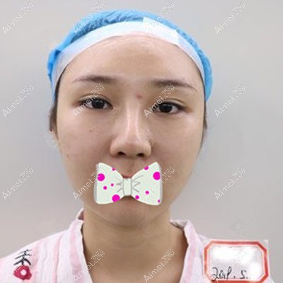 在双眼皮修复前看着有点假 在双眼皮修复前看着有点假