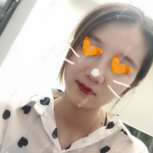 找宁波美莱隆鼻医生孙明磊做舒铂超肋鼻术后40天 找宁波美莱隆鼻医生孙明磊做舒铂超肋鼻术后40天