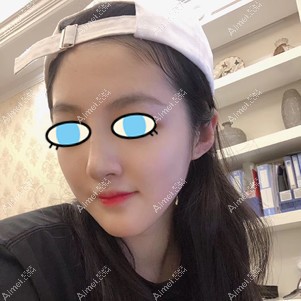 鼻综合一个月效果 鼻综合一个月效果