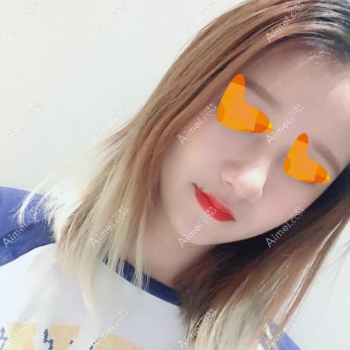 去宁波美莱做舒铂超肋鼻两个月效果图片 去宁波美莱做舒铂超肋鼻两个月效果图片