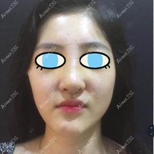 术前照片 术前照片