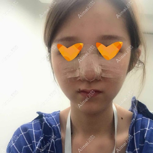 做舒铂超肋鼻综合手术第1天效果图片 做舒铂超肋鼻综合手术第1天效果图片