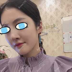 鼻综合一周效果 鼻综合一周效果