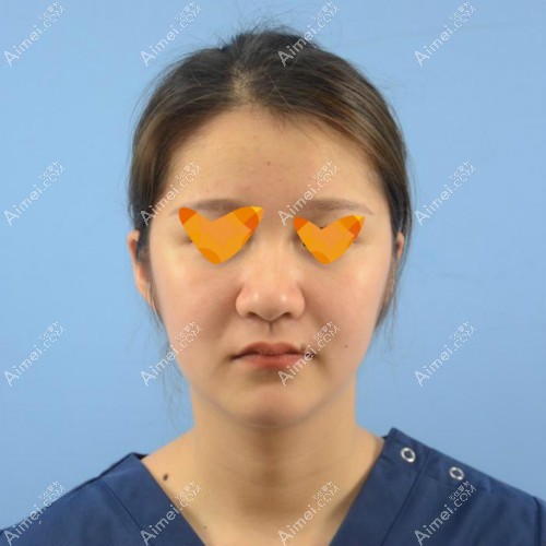 去宁波美莱做舒铂超肋鼻术前照片 去宁波美莱做舒铂超肋鼻术前照片