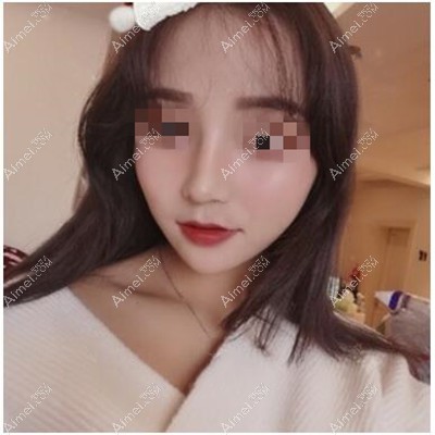 鼻综合术后3个月 鼻综合术后3个月