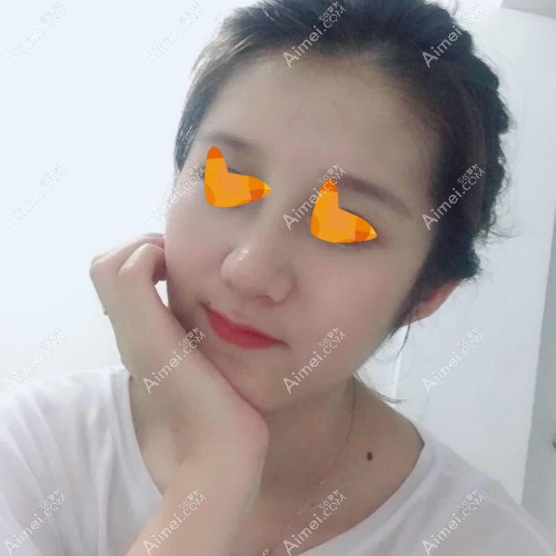 在宁波美莱做舒铂超肋鼻拆线后效果 在宁波美莱做舒铂超肋鼻拆线后效果