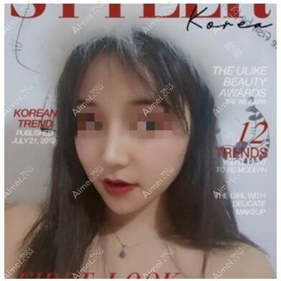 肋骨隆鼻术后2个月 肋骨隆鼻术后2个月