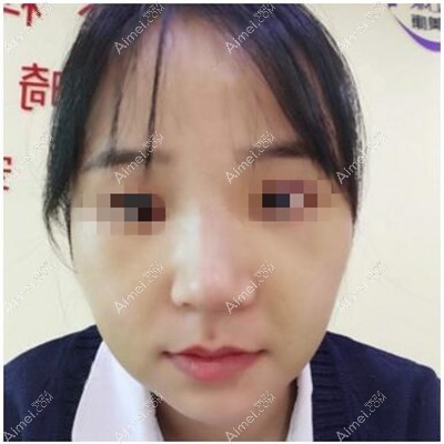 隆鼻手术前 隆鼻手术前