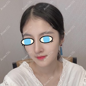 鼻综合半年效果 鼻综合半年效果