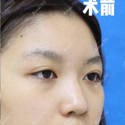 长沙鼻整形医生熊宜文多案例公开，有初鼻还有鼻修复可看