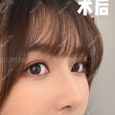 长沙鼻整形医生熊宜文多案例公开，有初鼻还有鼻修复可看