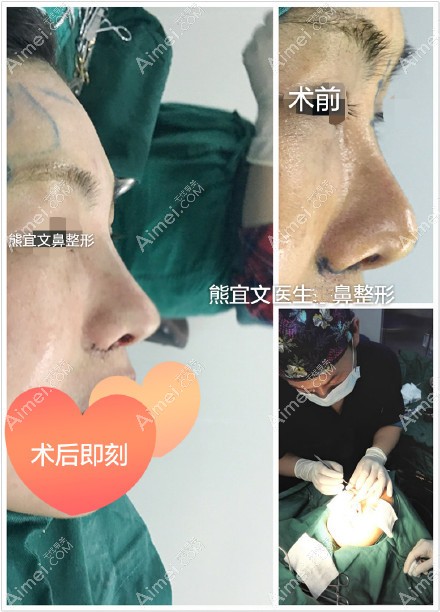硅胶假体+耳软骨鼻尖+鼻翼缩小即刻对比 硅胶假体+耳软骨鼻尖+鼻翼缩小即刻对比