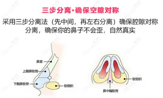 翟奔宇医生隆鼻后鼻子不会歪的原因 翟奔宇医生隆鼻后鼻子不会歪的原因