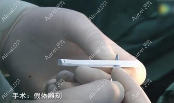 翟奔宇医生雕刻膨体假体 翟奔宇医生雕刻膨体假体