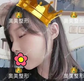 合肥奥美雷中元膨体加肋软骨隆鼻两个月恢复图 合肥奥美雷中元膨体加肋软骨隆鼻两个月恢复图