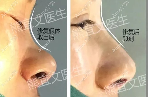 十年前做的假体隆鼻取出修复对比照 十年前做的假体隆鼻取出修复对比照