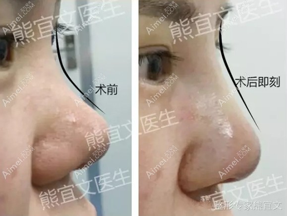 鼻头高但鼻梁塌,放了膨体材料在鼻背的术后即刻效果 鼻头高但鼻梁塌,放了膨体材料在鼻背的术后即刻效果