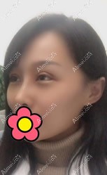 合肥奥美雷中元做肋骨鼻综合半个月的效果图 合肥奥美雷中元做肋骨鼻综合半个月的效果图