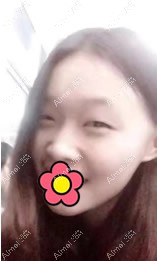 合肥奥美整形美容门诊部整鼻子前 合肥奥美整形美容门诊部整鼻子前