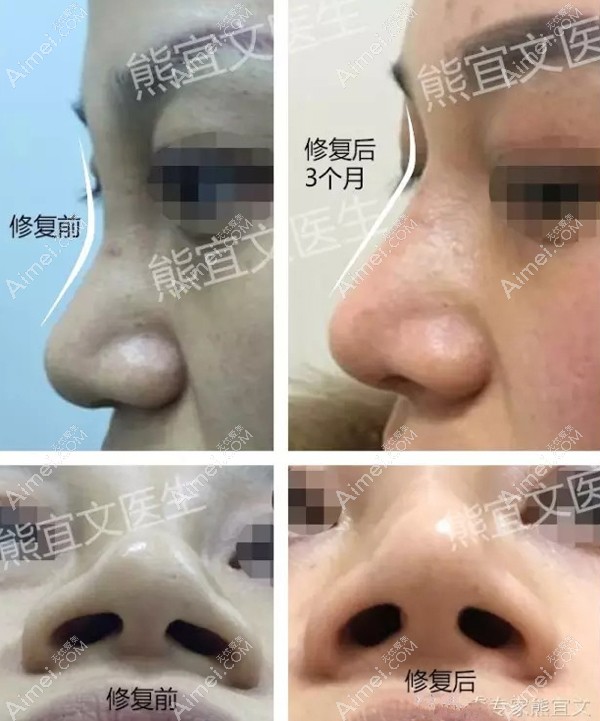 注射玻尿酸隆鼻取出修复 注射玻尿酸隆鼻取出修复