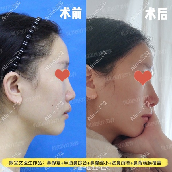 做完鼻修复+半肋鼻综合+鼻翼缩小+宽鼻缩窄+鼻背筋膜覆盖的案例 做完鼻修复+半肋鼻综合+鼻翼缩小+宽鼻缩窄+鼻背筋膜覆盖的案例