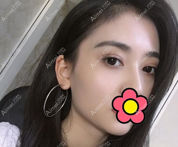 芜湖伊莱美徐世龙眼综合三个月恢复图 芜湖伊莱美徐世龙眼综合三个月恢复图